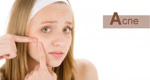 Acne Um problema que tem cura