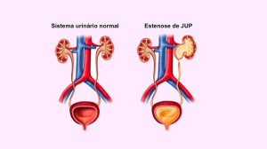 A estenose de Junção Uretero-Piélica (JUP), por Dr. Glauco Guedes.