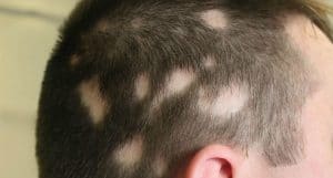 alopecia auto induzida - tricotilomania