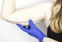 Braquioplastia - cirurgia de remoção do excesso de pele do braço