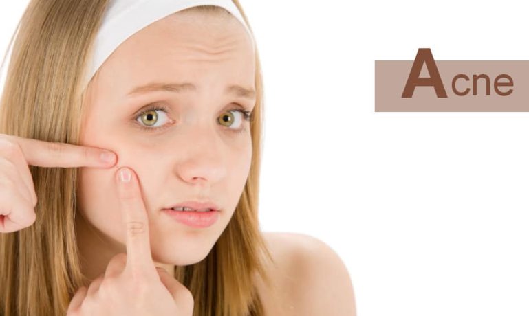 Acne Um problema que tem cura