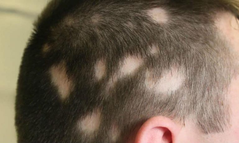 alopecia auto induzida - tricotilomania