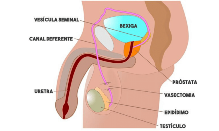 O que é e como é feita a vasectomia - por Dr. Glauco Guedes
