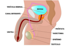 O que é e como é feita a vasectomia - por Dr. Glauco Guedes