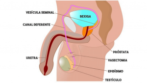 O que é e como é feita a vasectomia - por Dr. Glauco Guedes